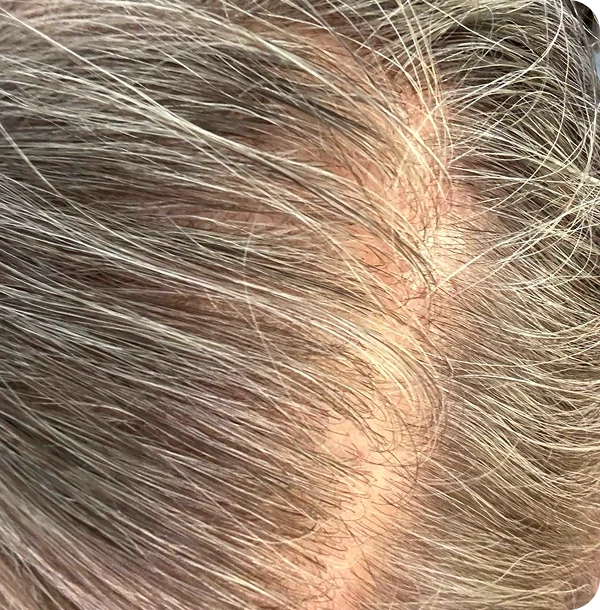 Balanced Scalp, Healthier Hair