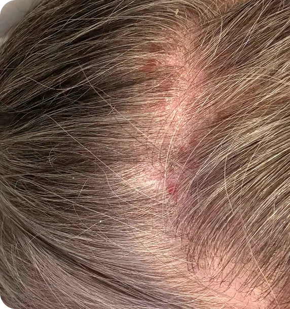 Balanced Scalp, Healthier Hair